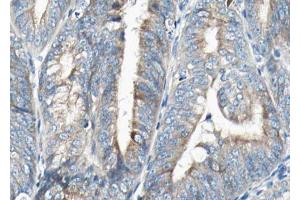 ABIN6268798 at 1/100 staining human Endometrial cancer tissue sections by IHC-P. (VEGFB antibody  (Internal Region))