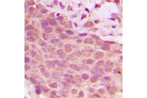Immunohistochemical analysis of NF-kappaB p65 (pS536) staining in human breast cancer formalin fixed paraffin embedded tissue section. (NF-kB p65 antibody  (C-Term, pSer536))