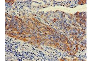 Immunohistochemistry of paraffin-embedded human cervical cancer using ABIN7157444 at dilution of 1:100