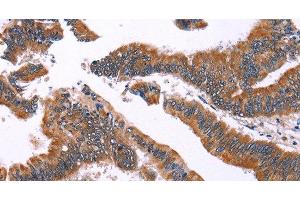 Immunohistochemistry of paraffin-embedded Human colon cancer using IRAK1BP1 Polyclonal Antibody at dilution of 1:40 (IRAK1BP1 antibody)