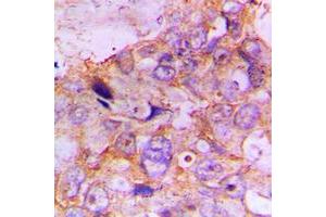 Immunohistochemical analysis of Caspase 7 staining in human lung cancer formalin fixed paraffin embedded tissue section. (Caspase 7 antibody  (N-Term))