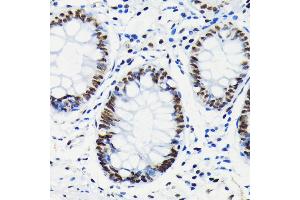 Immunohistochemistry of paraffin-embedded human colon using Phospho-Rb-S780 antibody (ABIN7269936) at dilution of 1:100 (40x lens). (Retinoblastoma 1 antibody  (pSer780))