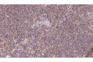 ABIN6273154 at 1/100 staining Human lymph cancer tissue by IHC-P. (RASGRP3 antibody  (Internal Region))
