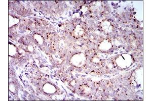 Immunohistochemical analysis of paraffin-embedded cervical cancer tissues using MRPL42 mouse mAb with DAB staining.