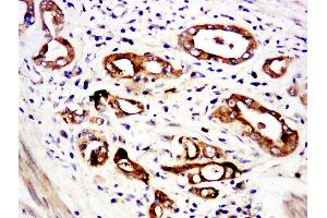 Paraformaldehyde-fixed, paraffin embedded human stomach cancer, Antigen retrieval by boiling in sodium citrate buffer (pH6. (C6ORF52 antibody  (AA 1-100))