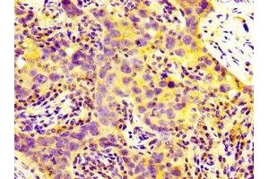 IHC image of ABIN7159247 diluted at 1:300 and staining in paraffin-embedded human pancreatic cancer performed on a Leica BondTM system. (MIA2 antibody  (AA 178-354))