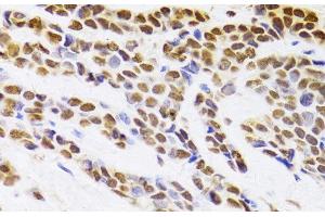 Immunohistochemistry of paraffin-embedded Human breast cancer using HDGF Polyclonal Antibody at dilution of 1:100 (40x lens).