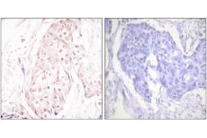 Immunohistochemistry analysis of paraffin-embedded human breast carcinoma tissue, using SENP8 Antibody.