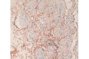 IHC-P analysis of Human Esophagus Cancer Tissue, with DAB staining. (COL6a3 antibody  (AA 463-624))