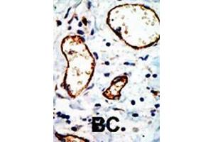 Formalin-fixed and paraffin-embedded human cancer tissue reacted with the primary antibody, which was peroxidase-conjugated to the secondary antibody, followed by DAB staining.