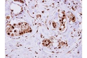 IHC-P Image ERH antibody detects ERH protein at cytosol on human breast cancer by immunohistochemical analysis.