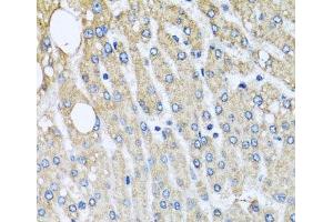 Immunohistochemistry of paraffin-embedded Human liver damage using UQCRC2 Polyclonal Antibody at dilution of 1:100 (40x lens). (UQCRC2 antibody)