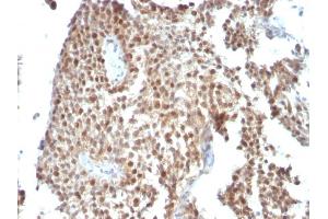 Formalin-fixed, paraffin-embedded human Bladder Carcinoma stained with p53 Monoclonal Antibody (SPM590) (p53 antibody)
