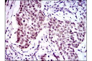Immunohistochemical analysis of paraffin-embedded breast cancer tissues using FOXP1 mouse mAb with DAB staining. (FOXP1 antibody  (AA 481-677))