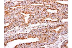 IHC-P Image PACSIN2 antibody [N2C3] detects PACSIN2 protein at cytosol on human colon carcinoma by immunohistochemical analysis. (PACSIN2 antibody)