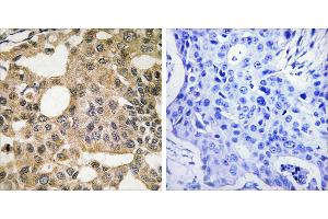 Peptide - +Immunohistochemistry analysis of paraffin-embedded human breast carcinoma tissue using BCL-XL antibody. (BCL2L1 antibody  (Internal Region))