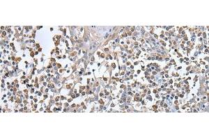 Immunohistochemistry of paraffin-embedded Human tonsil tissue using UBN1 Polyclonal Antibody at dilution of 1:130(x200)