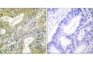 Immunohistochemistry analysis of paraffin-embedded human colon carcinoma tissue, using HEXB Antibody. (HEXB antibody  (AA 481-530))