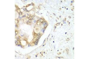 Immunohistochemistry of paraffin-embedded human liver cancer using VTI1B antibody (ABIN6132781, ABIN6150162, ABIN6150163 and ABIN6222854) at dilution of 1:100 (40x lens). (VTI1B antibody  (AA 1-210))