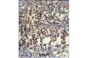 ANR49 Antibody (Center) (ABIN651157 and ABIN2840103) IHC analysis in formalin fixed and paraffin embedded human lymph carcinoma followed by peroxidase conjugation of the secondary antibody and DAB staining. (ANKRD49 antibody  (AA 80-109))