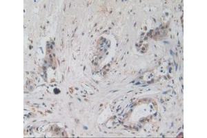 Detection of AREG in Human Pancreas Cancer Tissue using Monoclonal Antibody to Amphiregulin (AREG) (Amphiregulin antibody  (AA 20-100))