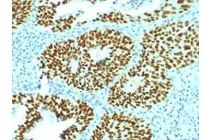 Immunohistochemical staining (Formalin-fixed paraffin-embedded sections) of human cervix cancer with SOX2 monoclonal antibody, clone SOX2/1792 . (SOX2 antibody  (AA 176-305))