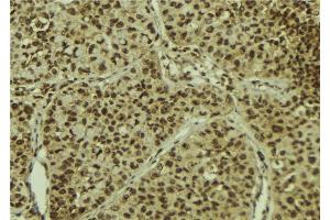 ABIN6278395 at 1/100 staining Human breast cancer tissue by IHC-P. (MGEA5 antibody)