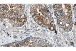 ABIN6274467 at 1/100 staining Human prostate tissue by IHC-P. (PMEPA1 antibody  (Internal Region))
