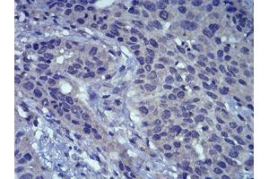 Immunohistochemical analysis of paraffin-embedded esophageal cancer tissues using LEF1 mouse mAb with DAB staining.