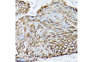Immunohistochemistry of paraffin-embedded Human cervical squamous cell carcinoma using MUC1 Rabbit mAb (ABIN7268687) at dilution of 1:100 (40x lens). (MUC1 antibody)