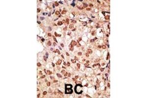 Formalin-fixed and paraffin-embedded human cancer tissue reacted with the primary antibody, which was peroxidase-conjugated to the secondary antibody, followed by DAB staining. (SIGLEC7 antibody  (N-Term))