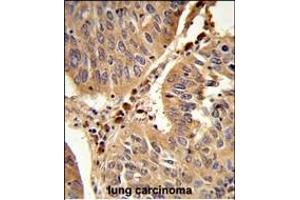 Formalin-fixed and paraffin-embedded human lung carcinoma reacted with PEX16 Antibody (Center), which was peroxidase-conjugated to the secondary antibody, followed by DAB staining.