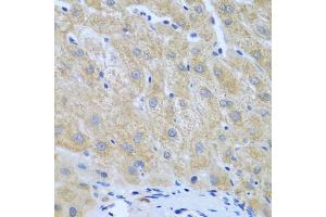 Immunohistochemistry of paraffin-embedded human liver cancer using FURIN antibody (ABIN5974735) at dilution of 1/100 (40x lens). (FURIN antibody)