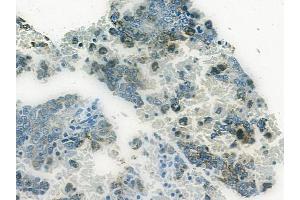 ABIN6265247 and ABIN6272432 at 1/100 staining human melanoma by IHC-P. (Sp3/4 antibody  (C-Term))