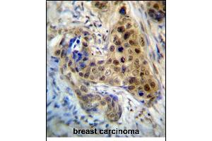RPL3 Antibody (Center) (ABIN657323 and ABIN2846397) immunohistochemistry analysis in formalin fixed and paraffin embedded human breast carcinoma followed by peroxidase conjugation of the secondary antibody and DAB staining. (RPL3 antibody  (AA 224-251))