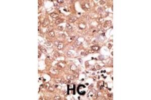 Formalin-fixed and paraffin-embedded human cancer tissue reacted with the primary antibody, which was peroxidase-conjugated to the secondary antibody, followed by DAB staining. (GDF2 antibody  (N-Term))