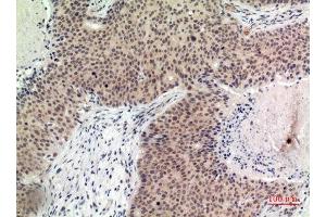 Immunohistochemistry (IHC) analysis of paraffin-embedded Human Breast Cancer, antibody was diluted at 1:100. (Histone H2B antibody  (Internal Region))