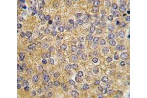 IHC analysis of FFPE human prostate carcinoma tissue stained with Urokinase antibody (PLAU antibody  (AA 60-90))