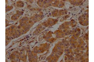 IHC image of ABIN7147846 diluted at 1:200 and staining in paraffin-embedded human breast cancer performed on a Leica BondTM system. (Clathrin Heavy Chain (CLTC) (AA 851-990) antibody)