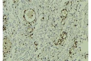 ABIN6272941 at 1/100 staining Human breast cancer tissue by IHC-P. (DEK antibody  (Internal Region))