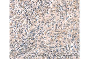 Immunohistochemistry of Human prostate cancer using DECR1 Polyclonal Antibody at dilution of 1:50