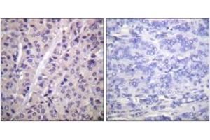 Immunohistochemistry analysis of paraffin-embedded human breast carcinoma, using A-RAF (Phospho-Tyr302) Antibody. (ARAF antibody  (pTyr302))