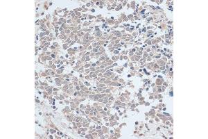 Immunohistochemistry of paraffin-embedded human lung cancer using ZNF581 antibody (ABIN6128960, ABIN6150520, ABIN6150521 and ABIN6217055) at dilution of 1:100 (40x lens). (ZNF581 antibody  (AA 1-90))