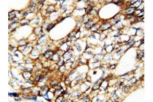 Anti-human FGF1 antibody, IHC(P) IHC(P): Human Mammary Cancer Tissue (FGF1 antibody  (AA 16-155))