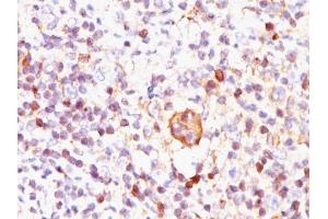 Formalin-fixed, paraffin-embedded Hodgkin's lymphoma stained with Bcl-x Mouse Monoclonal Antibody (BX006). (BCL2L1 antibody  (AA 3-14))