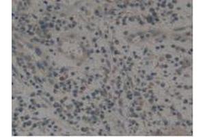 IHC-P analysis of Human Skin Cancer Tissue, with DAB staining. (Tissue factor antibody  (AA 34-251))