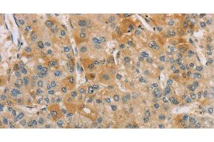 Immunohistochemistry of paraffin-embedded Human liver cancer tissue using CENPF Polyclonal Antibody at dilution 1:40 (CENPF antibody)