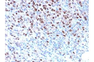 Formalin-fixed, paraffin-embedded human Melanoma stained with MITF Recombinant Rabbit Monoclonal Antibody (MITF/2987R).