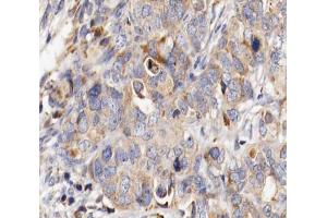 ABIN6266804 at 1/100 staining human ovarian cancer tissue sections by IHC-P.