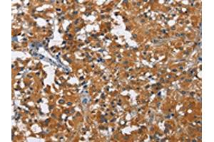 The image on the left is immunohistochemistry of paraffin-embedded Human thyroid cancer tissue using ABIN7130004(KLF7 Antibody) at dilution 1/60, on the right is treated with fusion protein. (KLF7 antibody)
